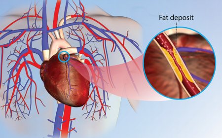Intense coronary disorder