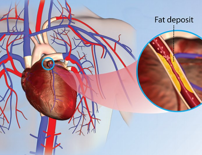 Intense coronary disorder